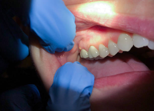 Best Emergency Gum Treatment in Hilltop, SC